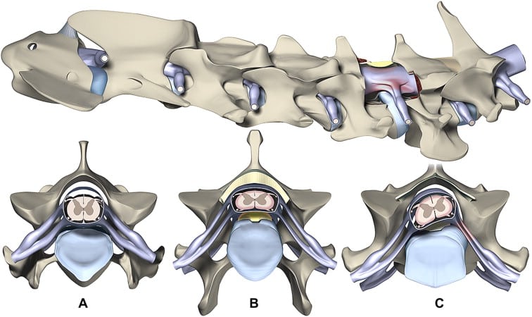Wobblers Syndrome in Great Danes: A Scary Neurological Disease Affects 4% of Great Danes 3 Wobblers Syndrome in Great Danes